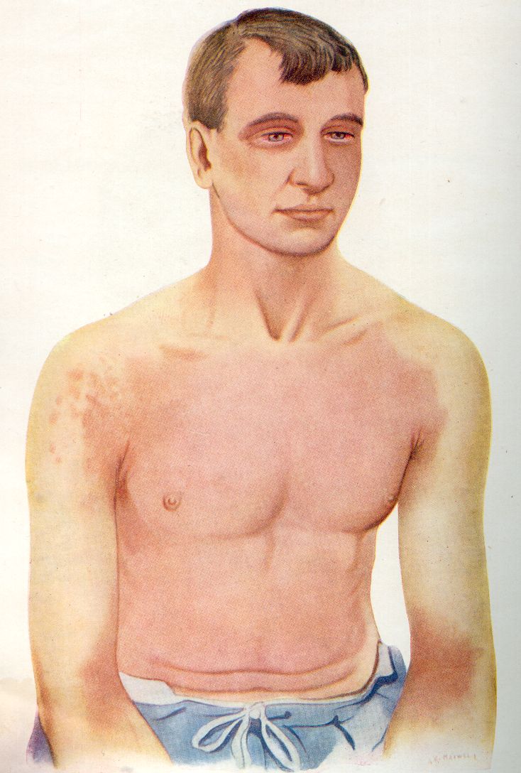 Erythema Of Skin From General Exposure To Mustard Gas Atlas Of Gas Poisoning In The Great War Medical Front Wwi