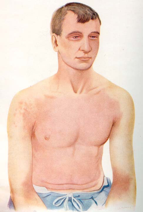 Effects of mustard gas, WW1 | Gas Warfare Medical Aspects | WWI Resource  Centre